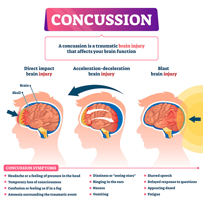 Concussion in AFL