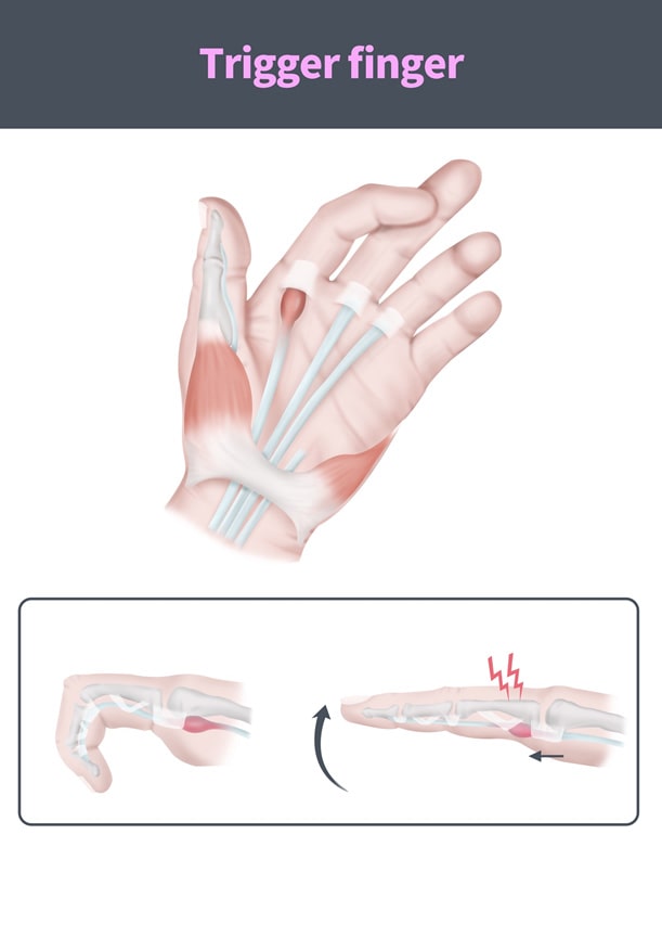 The Dreaded Golf Trigger Finger Injury Put a Stop to It Now
