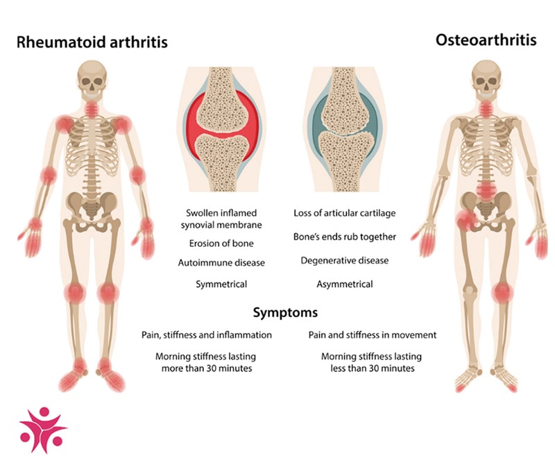 What is the most painful type of arthritis?