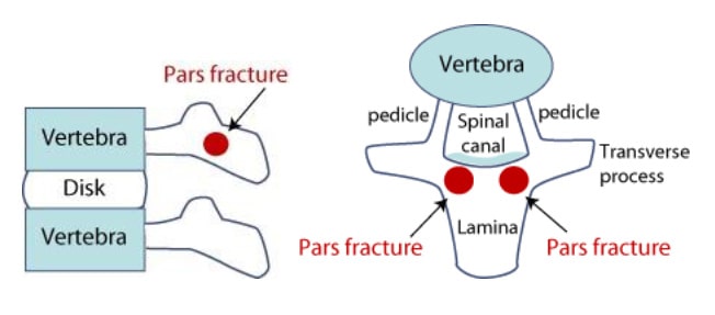 What is Pars Interarticularis Defect?