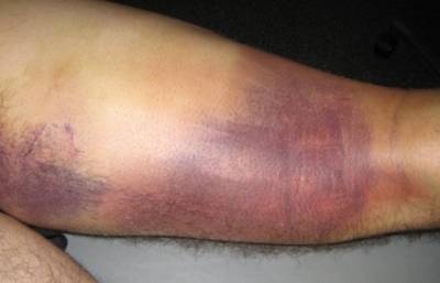 Muscle Contusion or CORK- What to do about severe bruising